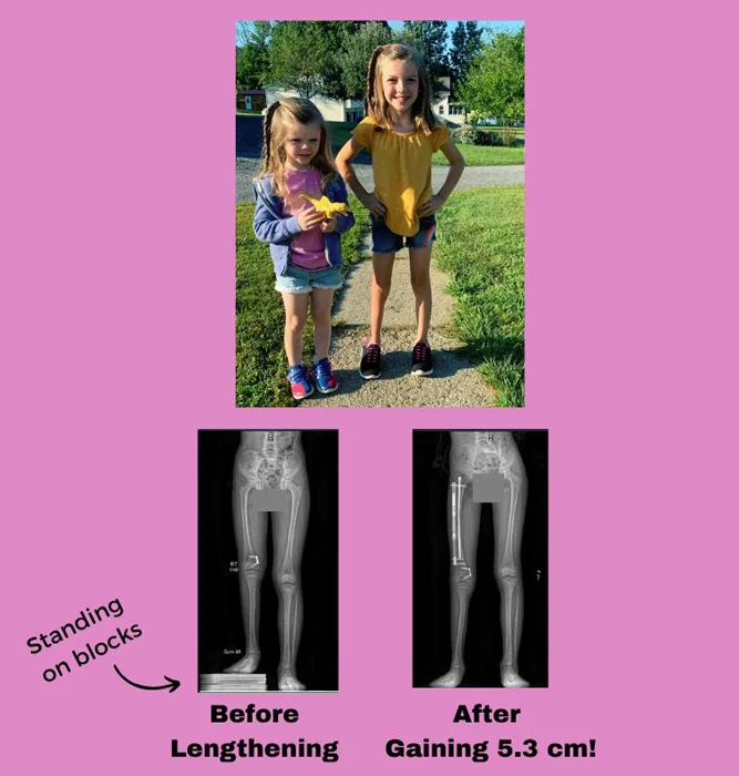 Young girl standing straight with even legs next to her younger sister outside and X-rays showing Quinelle