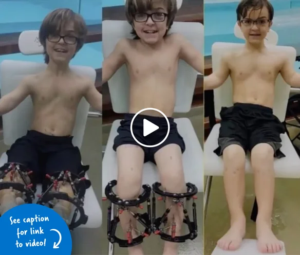 Three pictures of Preston on a hydrotherapy pool chair before, during, and after limb lengthening with external fixators