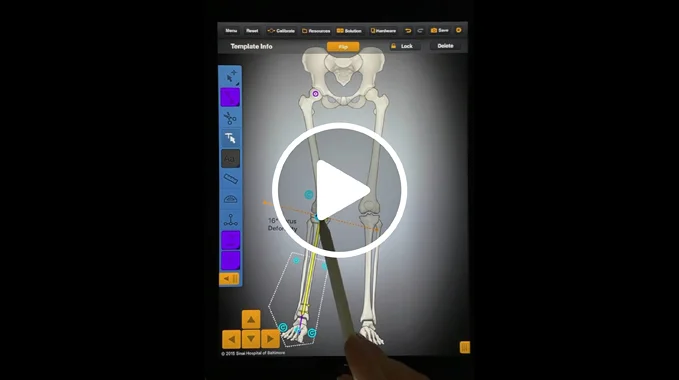 Screenshot of a video tutorial demonstrating how to use the Bone Ninja app for deformity correction