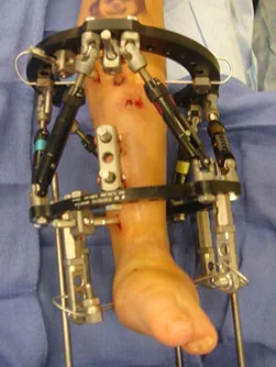 View from the front of a patient's leg with a Taylor Spatial Frame applied