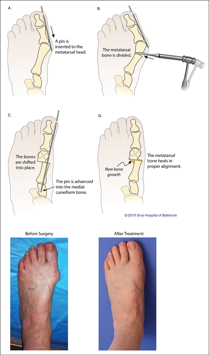 What is arthrodesis toe? How to treat and recover? - Arizona Foot