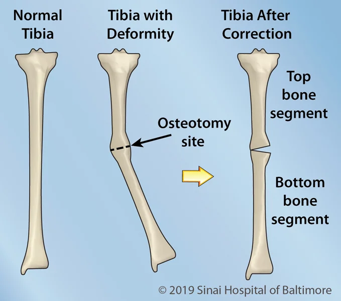 Top Tibia Clips