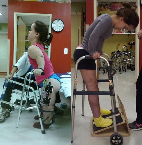 Two side-by-side pictures of Chandler; one at the start of her treatment with a walker and wearing external fixators on her legs in physical therapy, and one showing her significantly taller after lengthening doing a physical therapy exercise while using a walker for balance on an inclined foot board.