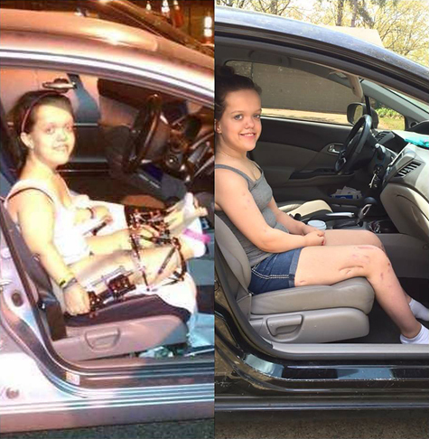 Two side-by-side pictures of Chandler in the passenger seat of a car; one showing her wearing external fixators on her legs at the start of treatment where her legs do not extend far beyond the car seat, before treatment, and one showing her after treatment where her legs not only extend beyond the car seat, but her feet now reach the car floor.