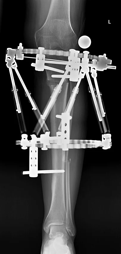 X-ray showing the Taylor Spatial Frame applied to leg
