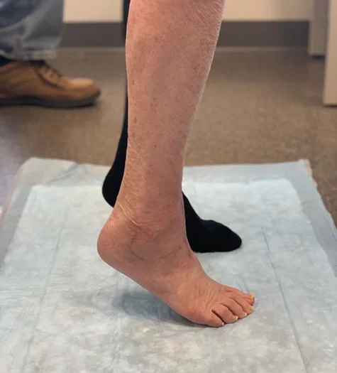 Sharon's foot after surgery