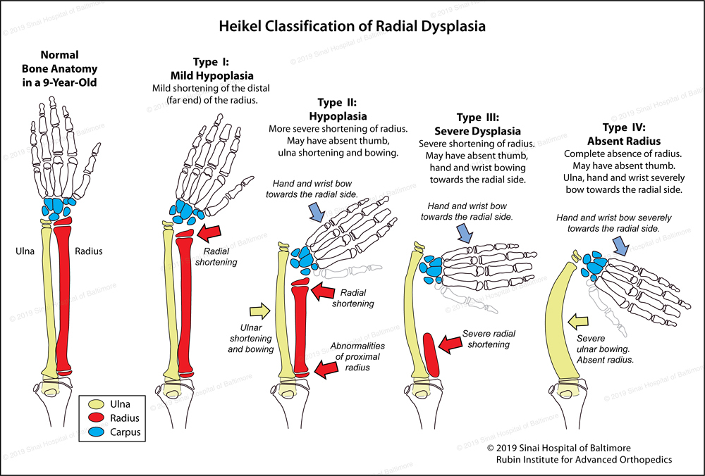 Radial Longitudinal Deficiency (Radial Club Hand)