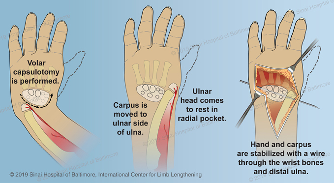 Club Hand  International Center for Limb Lengthening