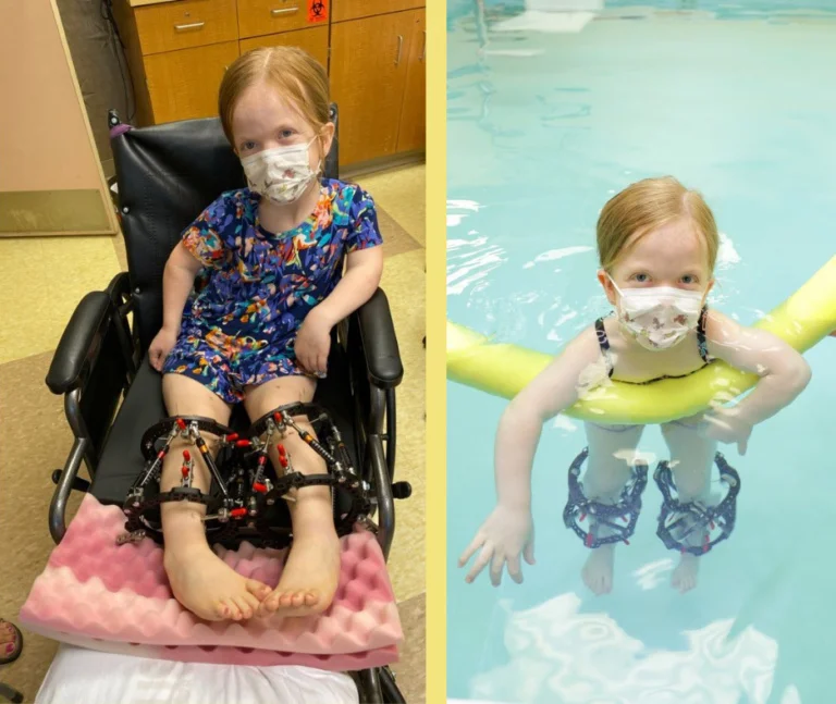 Anaïs in a wheelchair with bilateral external fixators on her legs, and Anaïs swimming in a hydrotherapy pool