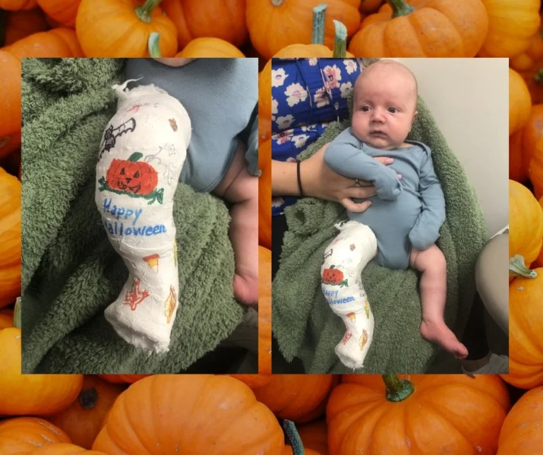 A baby with clubfoot with a cast on his leg that is decorated with a pumpkin for Halloween