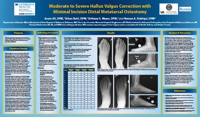 Research poster presented at the Annual Meeting of the American College of Foot and Ankle Surgeons in San Antonio, Texas in February 2020 - Moderate to Severe Hallux Valgus Correction with Minimal Incision Distal Metatarsal Osteotomy