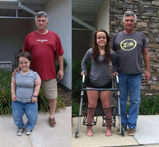Two side-by-side pictures of Chandler standing in front of the Hackerman-Patz House at Sinai Hospital with her father, before treatment and during treatment, She has an external fixator on each leg in the during treatment picture and it shows how much taller she is.