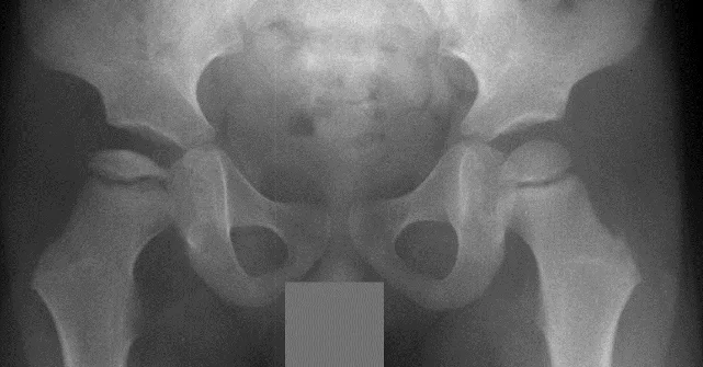 X-ray of human pelvis and femoral heads, showing Stage 3 (mid-collapse) of Perthes disease