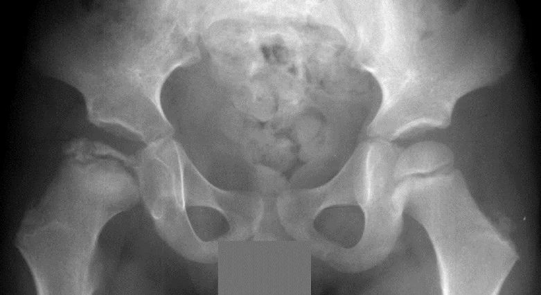 X-ray of human pelvis and femoral heads, showing Stage 5 (early fragmentation) of Perthes disease