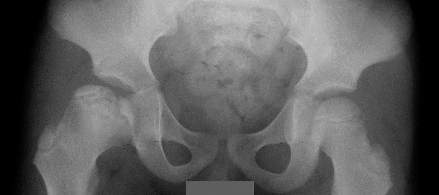 X-ray of human pelvis and femoral heads, showing Stage 8 (late reconstitution) of Perthes disease