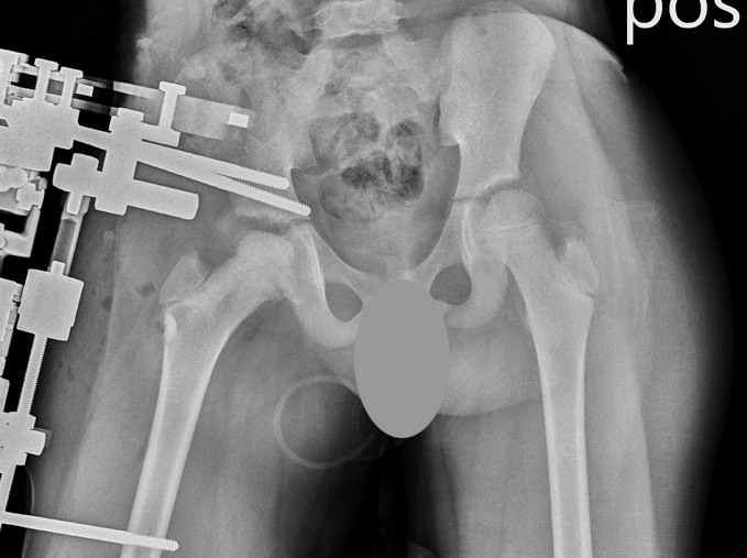 collapsed femoral head