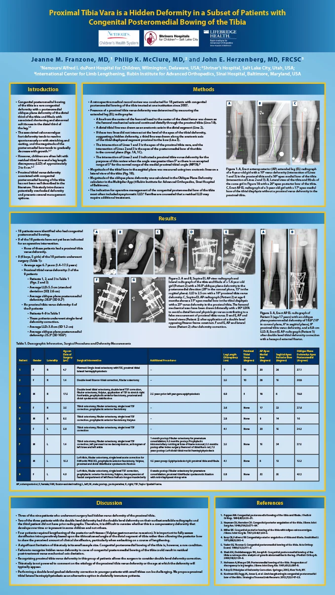 Research poster presented at the Annual Meeting of the European Paediatric Orthopaedic Society in Tel Aviv, Israel in April 2019 - Proximal Tibia Vara is a Hidden Deformity in a Subset of Patients with Congenital Posteromedial Bowing of the Tibia