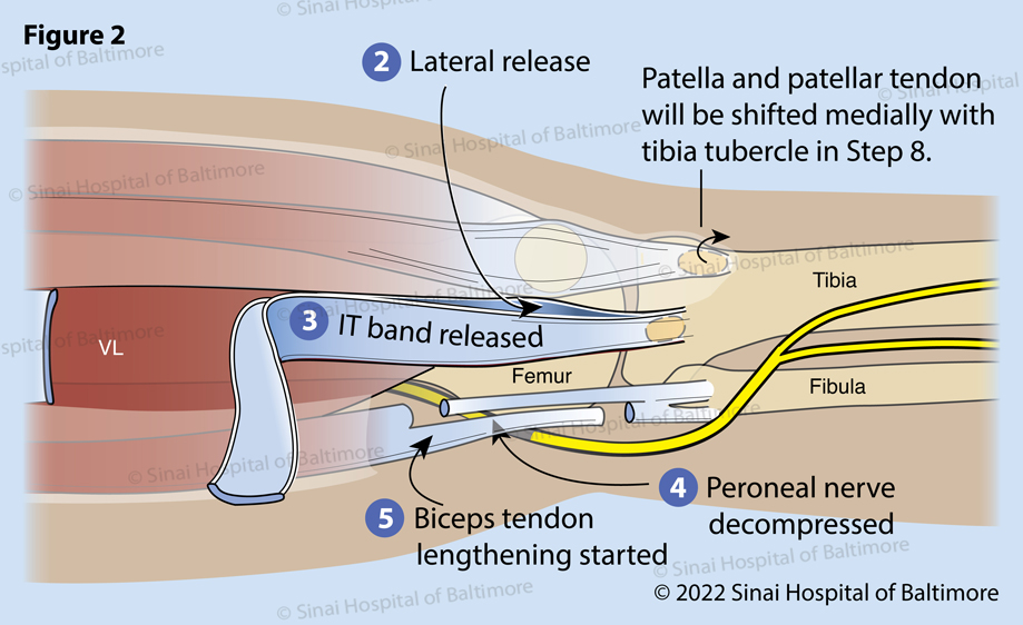 Congenital Dislocation of the Patella: Surgical Reconstruction