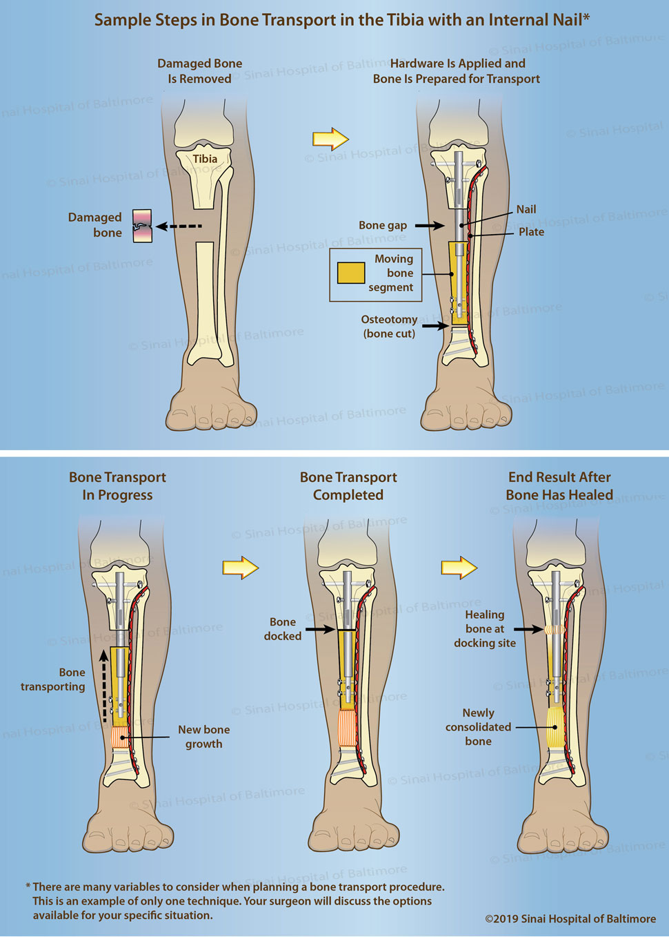 Midshaft Tibial Fracture | The Bone School