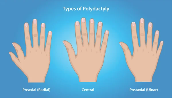 Polydactyly (Extra Fingers or Toes) and Corrective Surgery