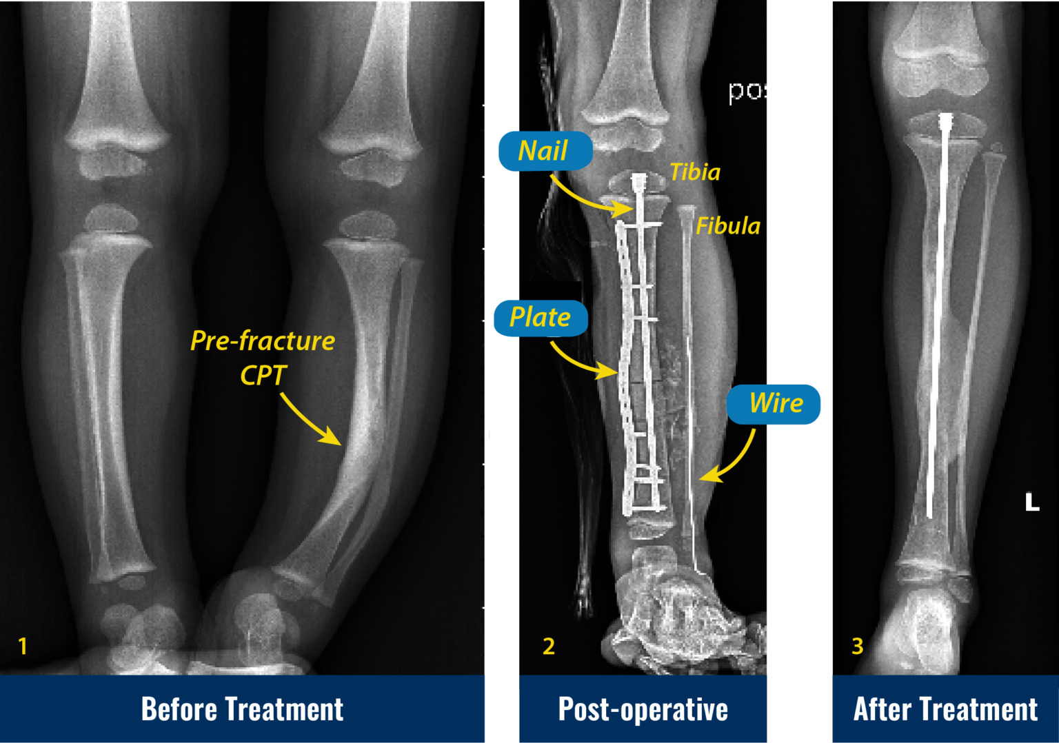 Congenital Pseudarthrosis Of The Tibia International Center For Limb Lengthening