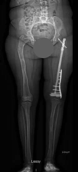 X-ray showing the corrected bone deformity after surgery using a combination of fixator assisted nailing and plating techniques