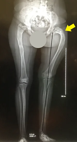 X-ray showing how the hip and femur bone were deformed as a result of fibrous dysplasia