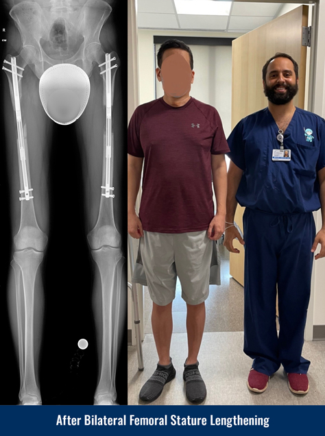 https://www.limblength.org/wp-content/uploads/Xray-and-Photo-After-Bilateral-Femur-Height-Increase-Surgery-Taller.jpg