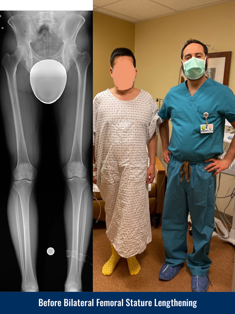 https://www.limblength.org/wp-content/uploads/Xray-and-Photo-Before-Bilateral-Femur-Height-Increase-Surgery-Taller.jpg